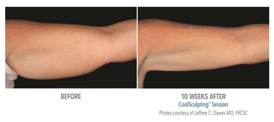 CoolSculpting® before and after
