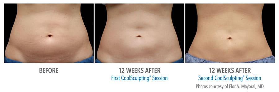 CoolSculpting® before and after