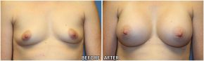 Breast Augmentation 37