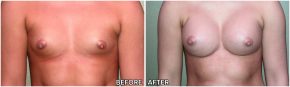 breast-augmentation31