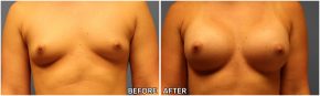 breast-augmentation33