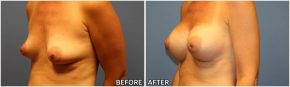 breast-augmentation34