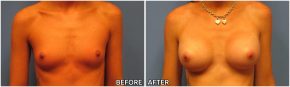 breast-augmentation34