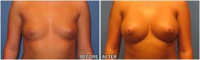 breast-augmentation38