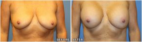 breast-augmentation39