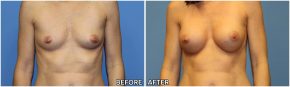 breast-augmentation39
