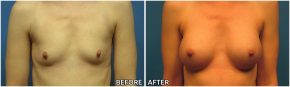 breast-augmentation41