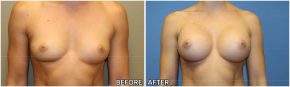 breast-augmentation42