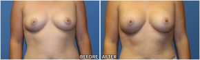 breast-augmentation43