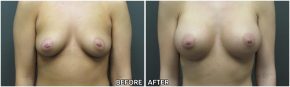 breast-augmentation44