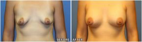 breast-augmentation45
