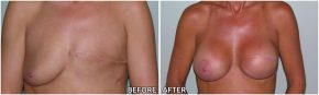 breast-reconstruction10