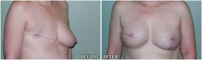 breast-reconstruction11