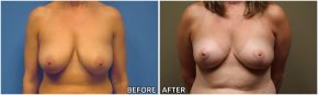 breast-reconstruction15