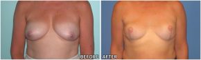breast-reconstruction6
