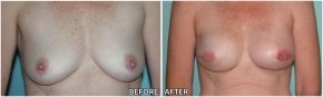 breast-reconstruction8