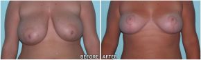breast-reduction11