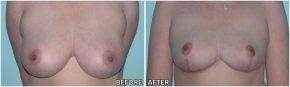 breast-reduction12