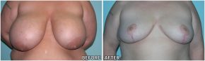breast-reduction14