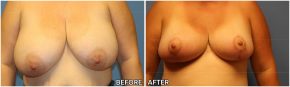 breast-reduction16