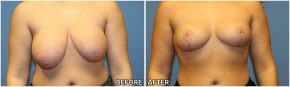 breast-reduction21