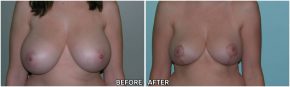 breast-reduction6